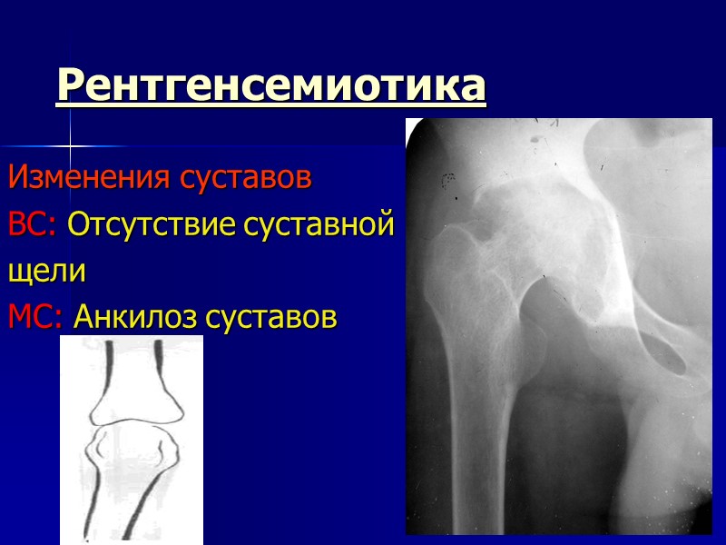 Рентгенсемиотика Изменения суставов ВС: Отсутствие суставной  щели МС: Анкилоз суставов